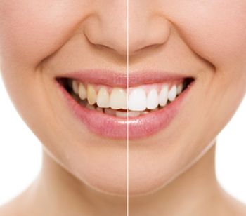 بلیچینگ دندان یا لمینت؟ یک دو راهیِ شک برانگیز!