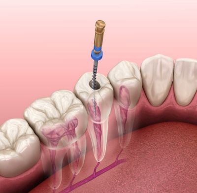 درمان کانال ریشه دندان