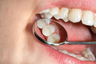 فواید و عوارض کامپوزیت دندان