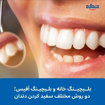 بلیچینگ خانه و بلیچینگ آفیس؛ دو روش مختلف سفید کردن دندان