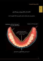 تصویر  ساکشن پروتز کامل چیست؟