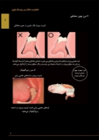 تصویر  ساکشن پروتز کامل چیست؟