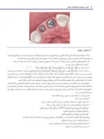 تصویر  عوارض پیچیده ی ایمپلنت های دندانی