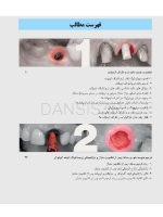 تصویر  زیبایی شناسی بافت نرم و پرسلن های صورتی رنگ در درمان با ایمپلنت