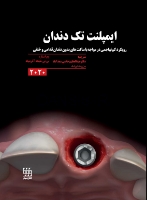 تصویر  ایمپلنت تک دندان 2020