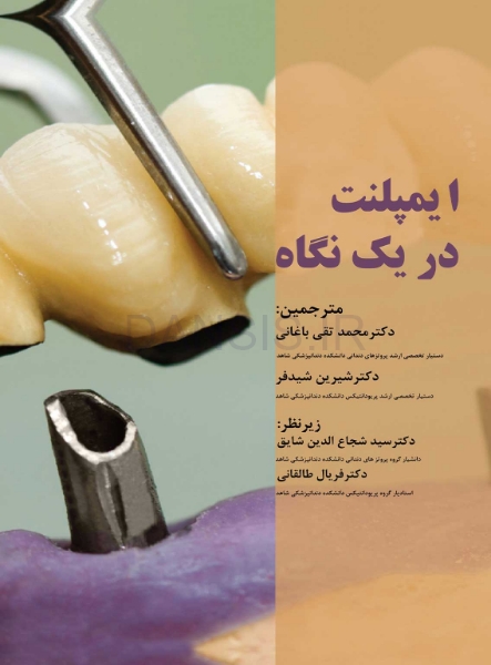 تصویر  ایمپلنت در یک نگاه