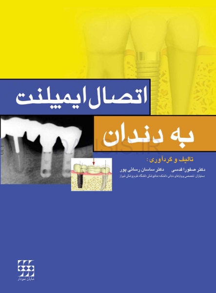 تصویر  اتصال ایمپلنت به دندان