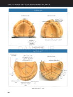 تصویر  ساکشن پروتز کامل فک پایین به صورت “پیشرفته”