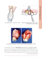 تصویر  اصول و روش های کشیدن محافظه کارانه دندان